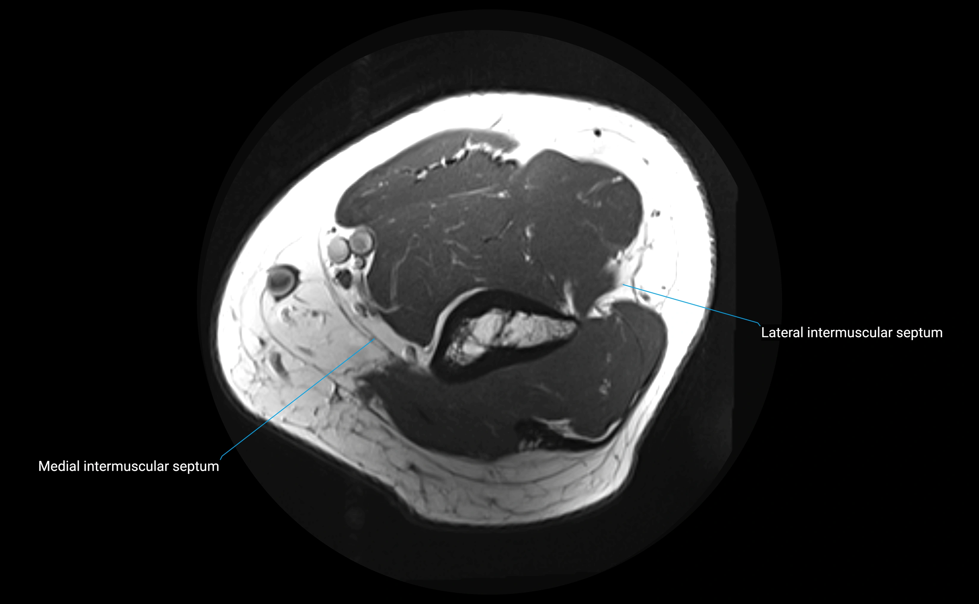 MRI elbow ligaments axial cross sectional anatomy 3T  radiology  image-img-00001-00004.webp